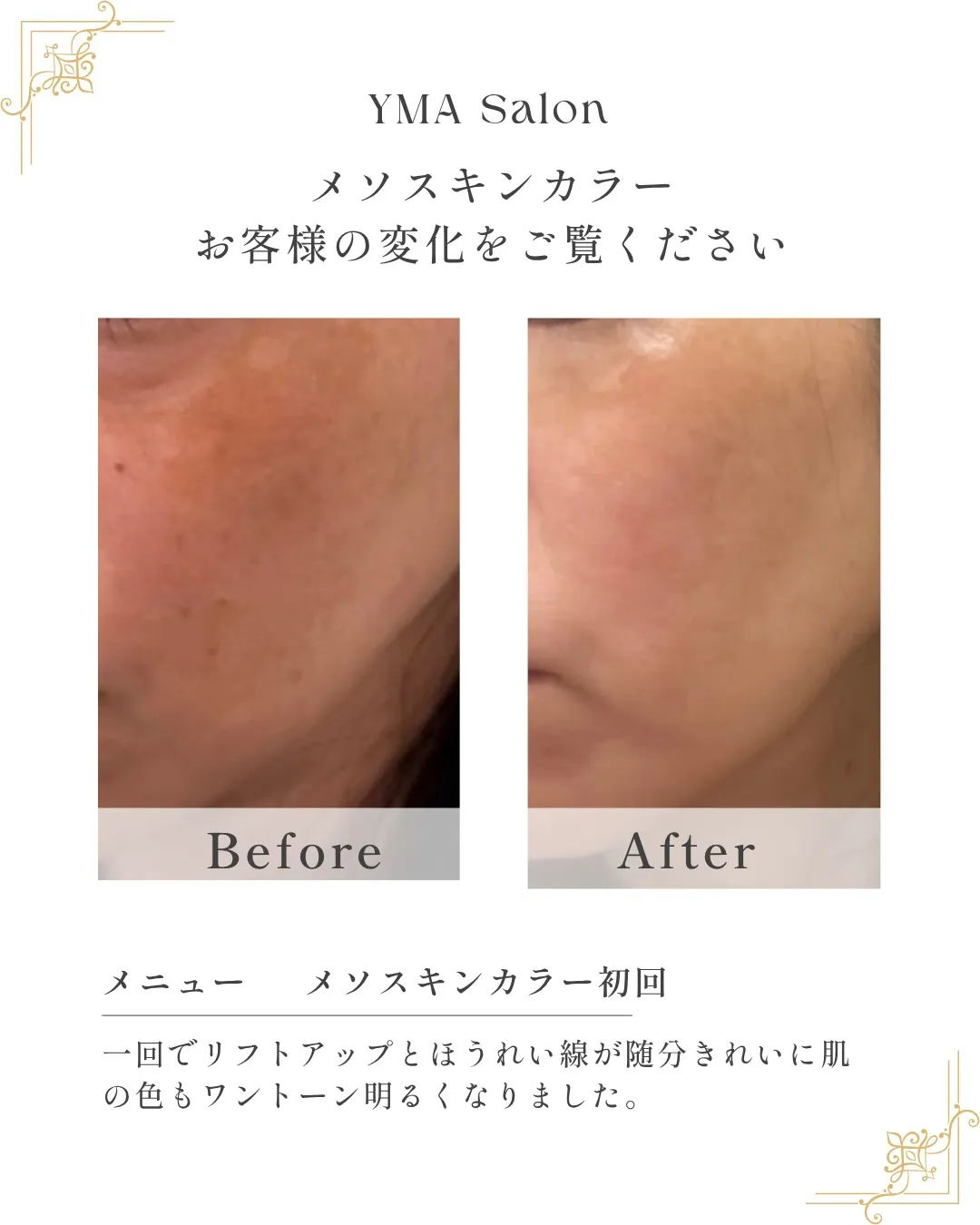 メソスキンカラーでここまで変わる。