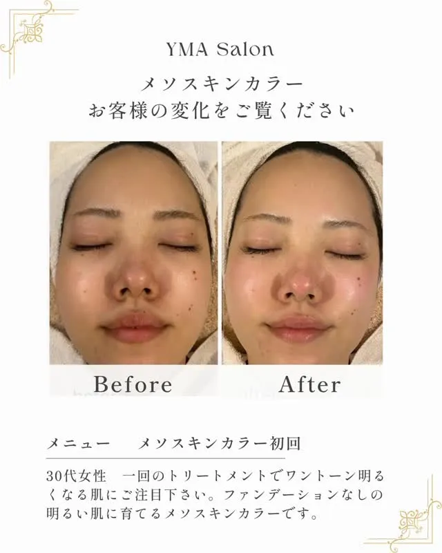 メソスキンカラー、大人気施術です。