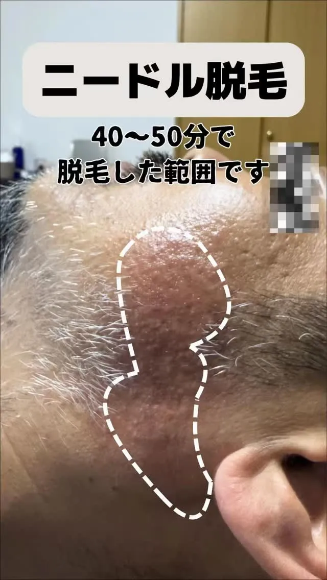 ニードル脱毛は少し時間がかかります。